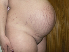Striae distensae nebli pajizévky