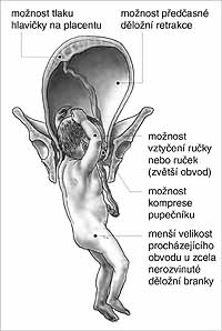 konec pánevní - zvláštnosti oproti porodu hlavičkou napřed