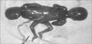Dicephalus tetrabrachius monoomphaliens, jiný možný název: hypsiloides dipus