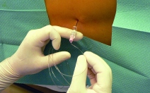 Epidurální analgezie - obrázek Epidurální analgezie - obrázek